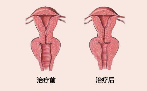 郑州新世纪女子医院做阴道紧缩术有哪些好处?