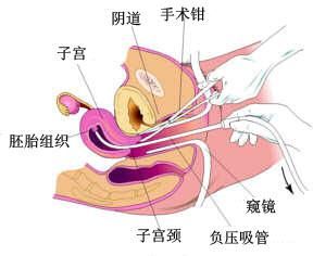 意外怀孕选择人流医院有多重要？