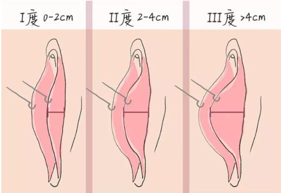 郑州新世纪女子医院阴唇整形的安全性怎么样?