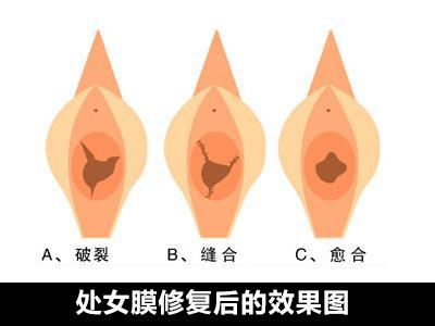 处女膜修复手术前要做哪些检查?