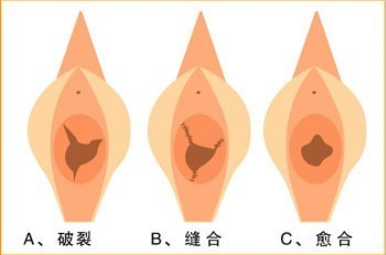 郑州处女膜修复效果怎么样？如何进行修复？