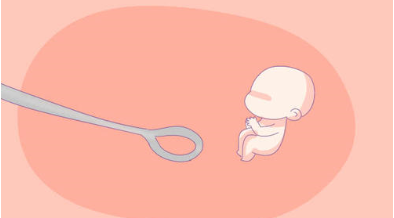 无痛引产后如何护理?
